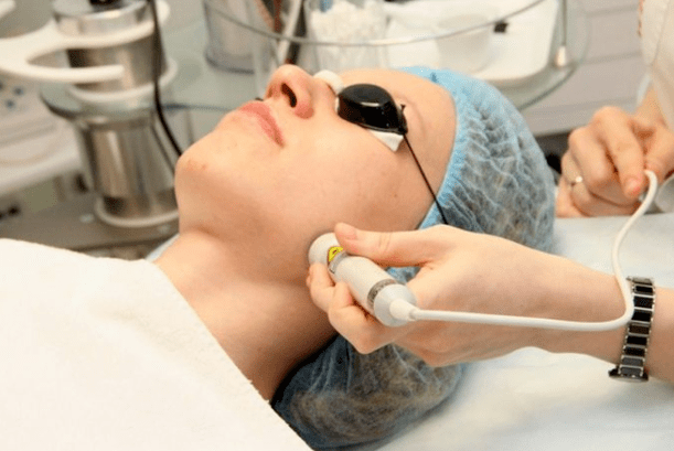 Laserska biorevitalizacija