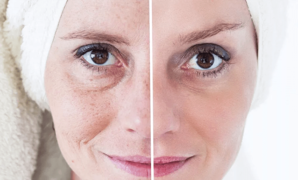 lasersko pomlađivanje lica